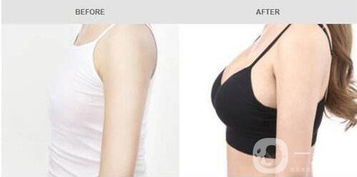 雙平面隆胸的缺點(diǎn)是什么 *果自然嗎