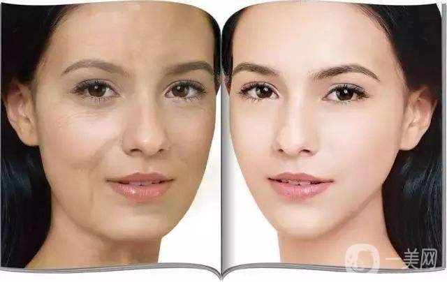 法令紋深怎么辦 法令紋深如何消除