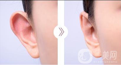 招風(fēng)耳手術(shù)多少錢(qián)