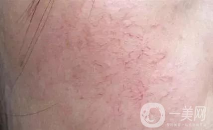 臉上長紅血絲怎么辦?去紅血絲攻略親測*