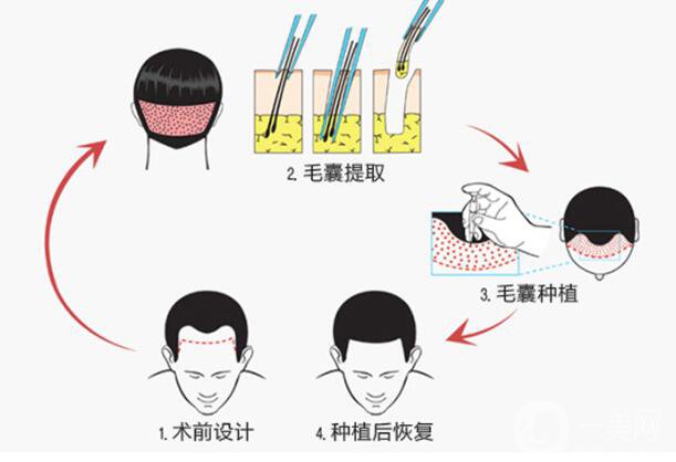 植發(fā)的*果是*性的嗎 它的原理是什么？