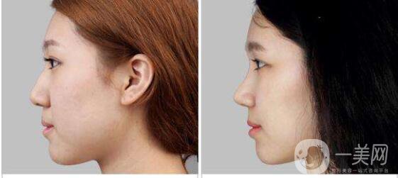 印度鼻成形術(shù)*果怎么樣