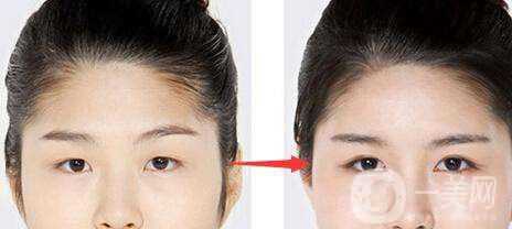 開眼角的風險大嗎 開眼角*果好不好