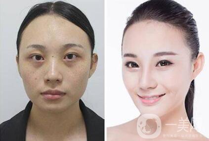 隆鼻整容有哪些方法 隆鼻后注意事項