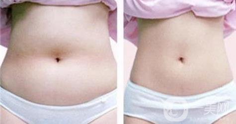 腹部吸脂的費(fèi)用,腹部吸脂注意事項(xiàng)