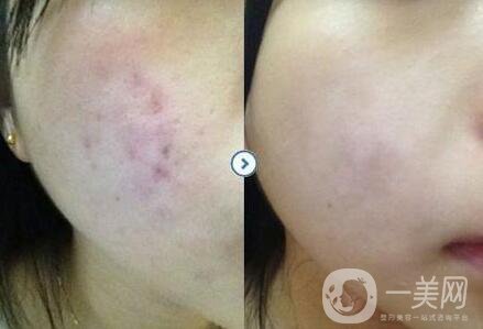 激光祛痘印的費用,激光祛痘印術后護理