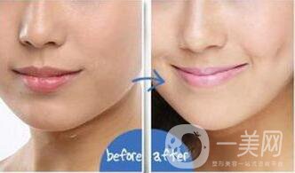 人造酒窩前后照片,人造酒窩多少錢(qián)