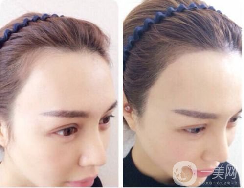 韓式半*發(fā)際線危害 發(fā)際線術(shù)后注意事項(xiàng)