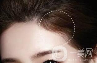 韓式半*發(fā)際線危害 發(fā)際線術(shù)后注意事項(xiàng)