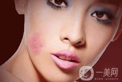 去紅色胎記大概多少錢 去紅色胎記費(fèi)用