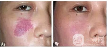 去紅色胎記大概多少錢 去紅色胎記費(fèi)用