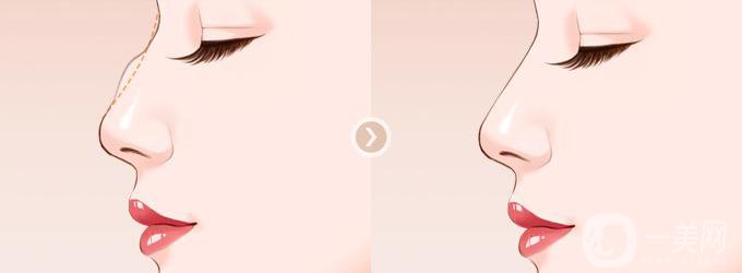 駝峰鼻矯正價錢 駝峰鼻的樣子