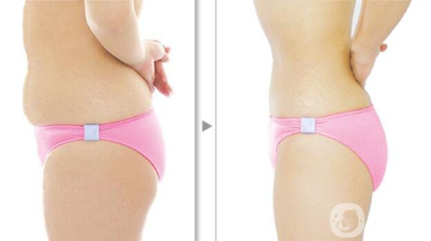 腰腹部吸脂減肥手術(shù)*嗎 多少錢呢