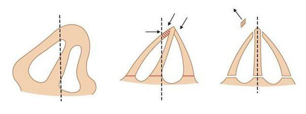 矯正歪鼻梁要多少錢 矯正歪鼻的方法