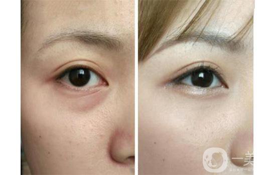 造成下眼皮松弛的原因 下眼皮松弛需要做手術嗎