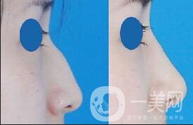 北京駝峰鼻矯正好嗎,北京駝峰鼻矯正*果