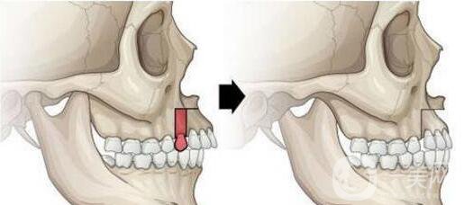 天包地矯正前后圖片
