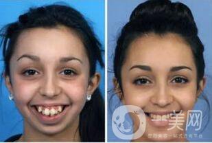 天包地矯正前后圖片