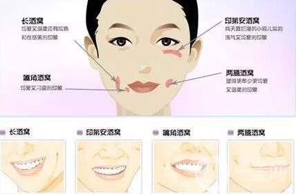 酒窩整形價格,酒窩整形多久恢復