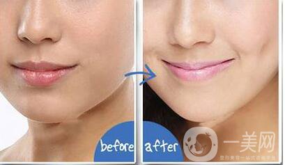 酒窩整形價格,酒窩整形多久恢復