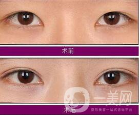 埋線雙眼皮*果圖