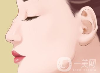 駝峰鼻手術(shù)價(jià)格一般是多少？