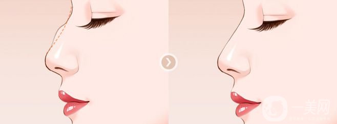 駝峰鼻手術(shù)價(jià)格一般是多少？