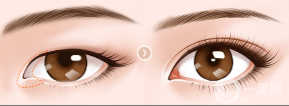 開眼角的*果怎么樣 好不好？