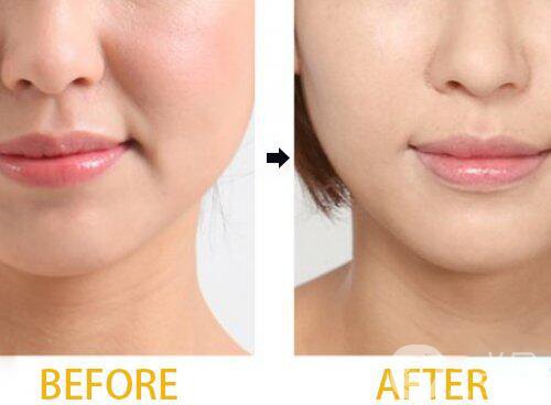 自體脂肪填充鼻唇溝怎么樣 能保持多久？