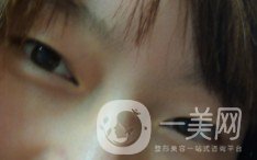 上海九院張波醫(yī)生好不好？醫(yī)生雙眼皮案例附照片