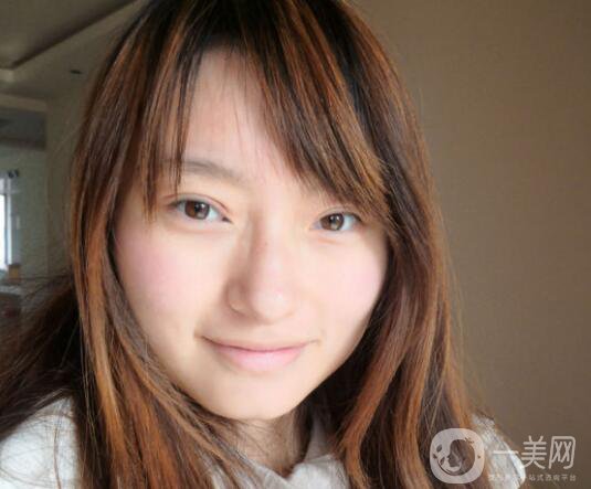 上海九院張波醫(yī)生好不好？醫(yī)生雙眼皮案例附照片