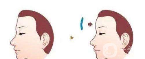 假體豐額頭的副作用有哪些 *嗎