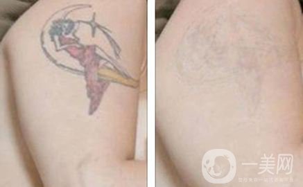 正常黑紋身洗幾次合適 洗紋身手術(shù)*嗎