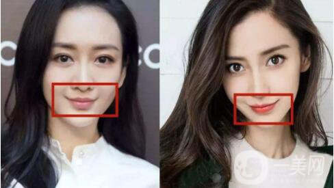 什么是微笑提升手術(shù) 持續(xù)時間是多久