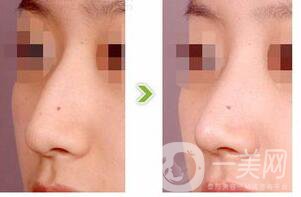 歪鼻整形費(fèi)用,歪鼻整形貴不貴