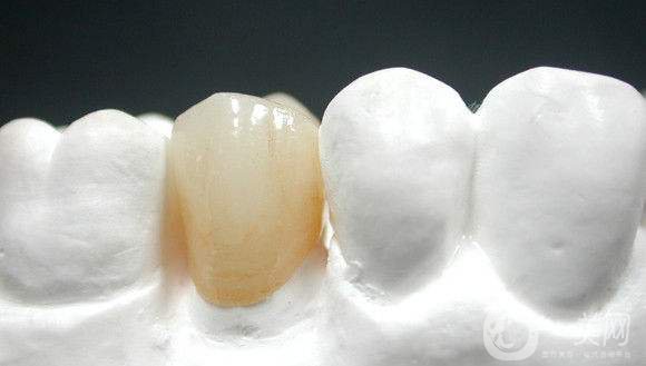 烤瓷牙一般要多少錢 貴不貴？