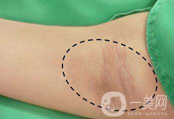 腋臭手術(shù)多久恢復 術(shù)后何如護理