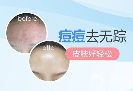 紅藍(lán)光祛痘副作用有哪些