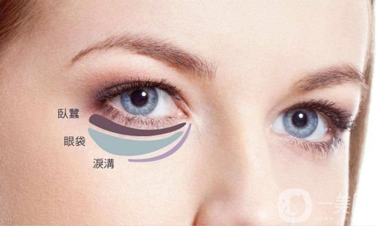 玻尿酸豐臥蠶后遺癥 恢復時間是多久