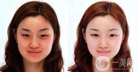 祛痘微針幾次多久見* 祛痘微針需要打幾次