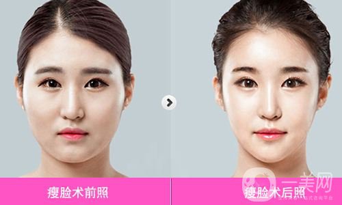 等離子溶脂價(jià)格 等離子溶脂瘦大腿可以嗎