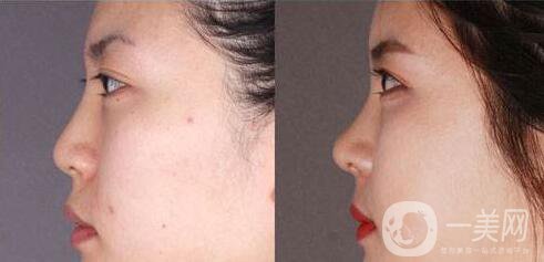 鼻成形術(shù)是什么 鼻成形術(shù)的作用是什么