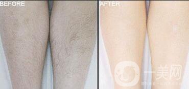 北京光子脫毛價格