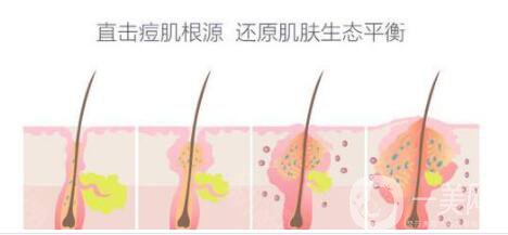 紅藍(lán)光祛痘印多少錢 紅藍(lán)光祛痘印貴嗎