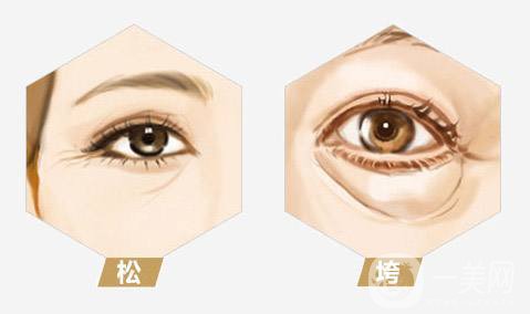 眼周年輕化手術(shù)費(fèi)用 術(shù)后需要注意什么