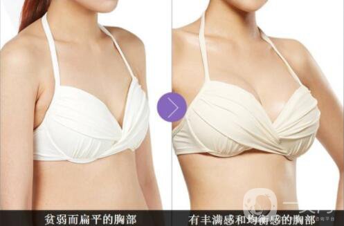 自體脂肪隆胸多久不疼？ 脂肪隆胸的害處？