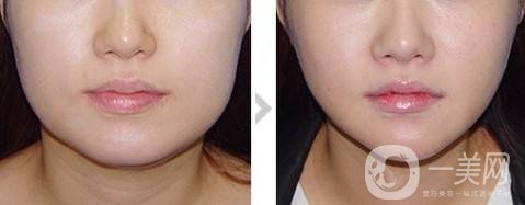 面部吸脂多久能看到*果 注意事項是什么