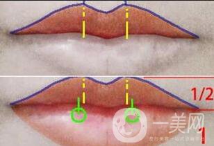 厚唇改薄手術(shù)注意事項