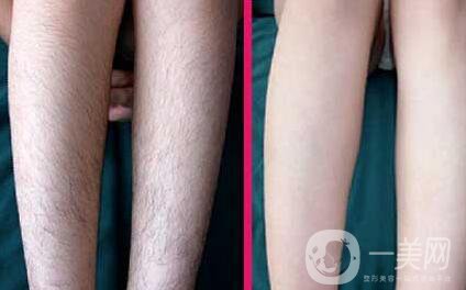 全身光子脫毛價格