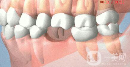 人工種植牙價(jià)格,人工種植牙壽命是多少年